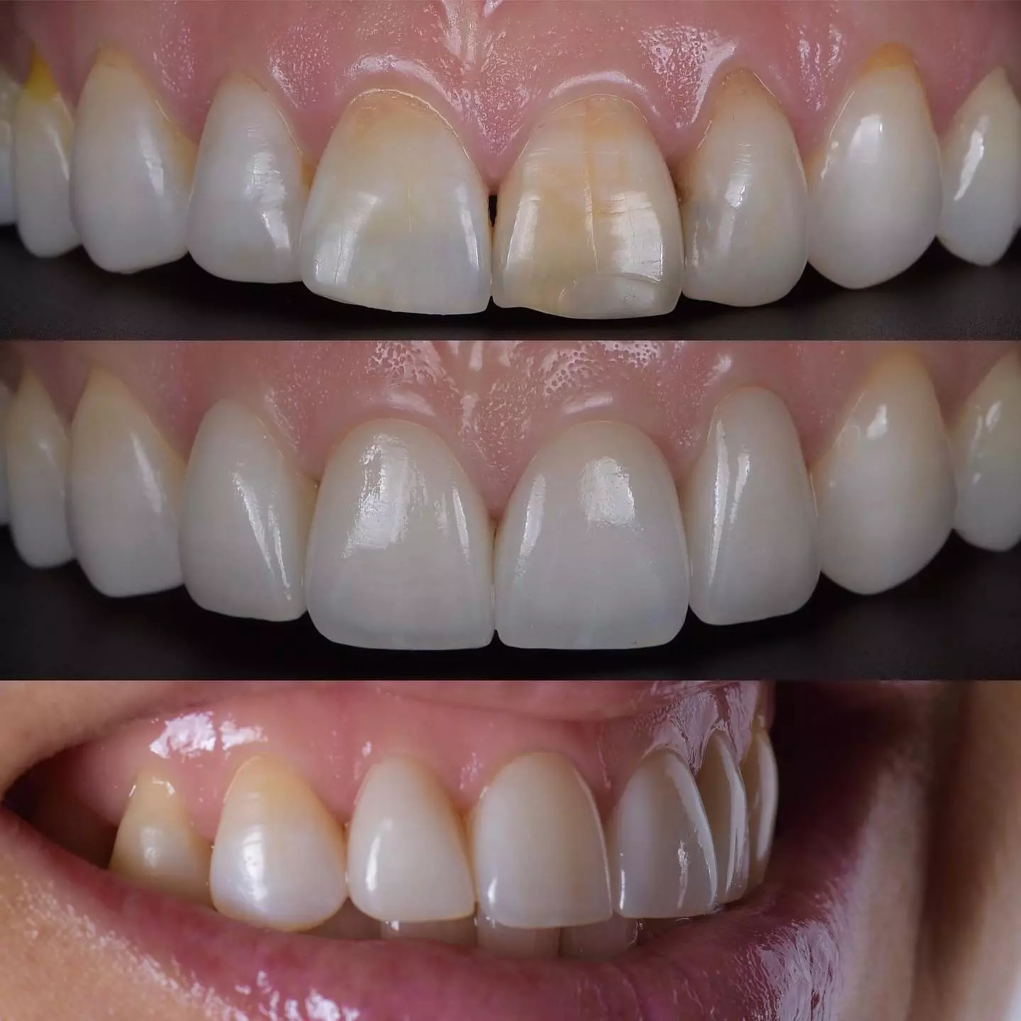 Dentalni implantati i all on 4, Samobor, RH