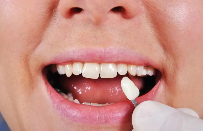 Izbjeljivanje zubi Profesionalno izbjeljivanje zubi
