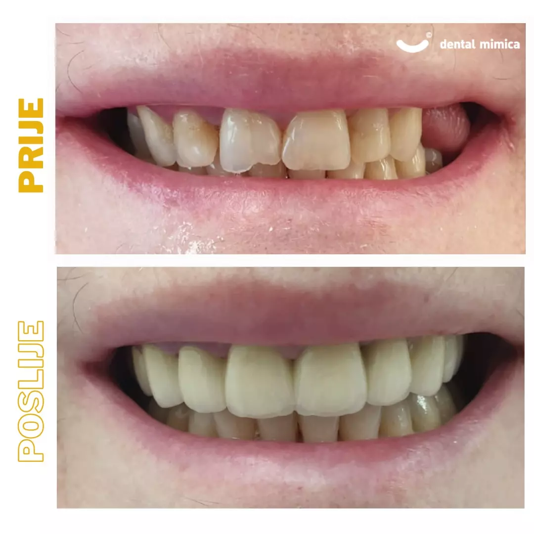 Estetske zubne krune grad Zagreb, Hrvatska