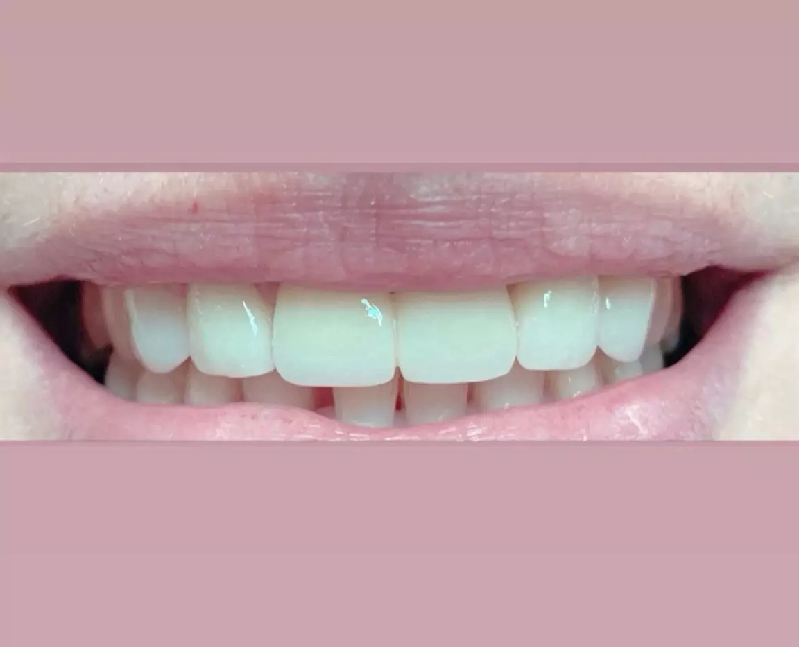 Estetska stomatologija Banja Luka u BiH