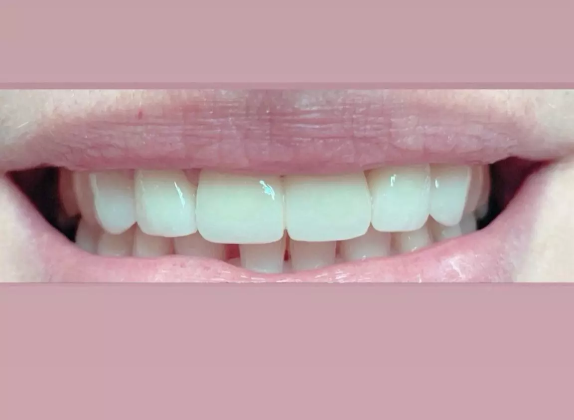 Implantologija Banja Luka