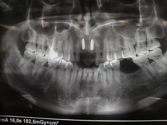 Izbjeljivanjezubiidječjastomatologija,Rijeka