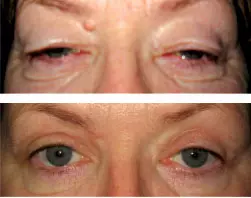 Kirurgija_vjeđa_u_Zagrebu Kirurgija_vjeđa_u_Zagrebu