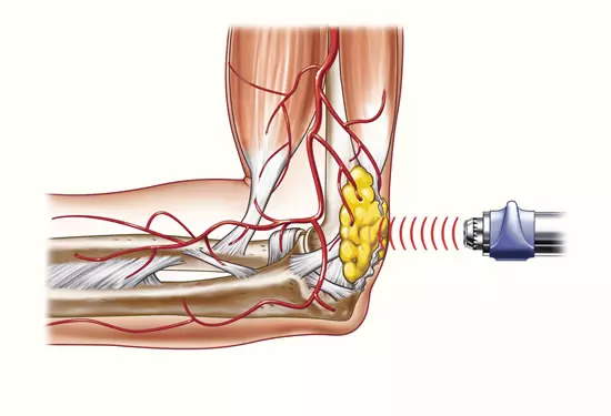 Laser visokog intenziteta-Zagreb 