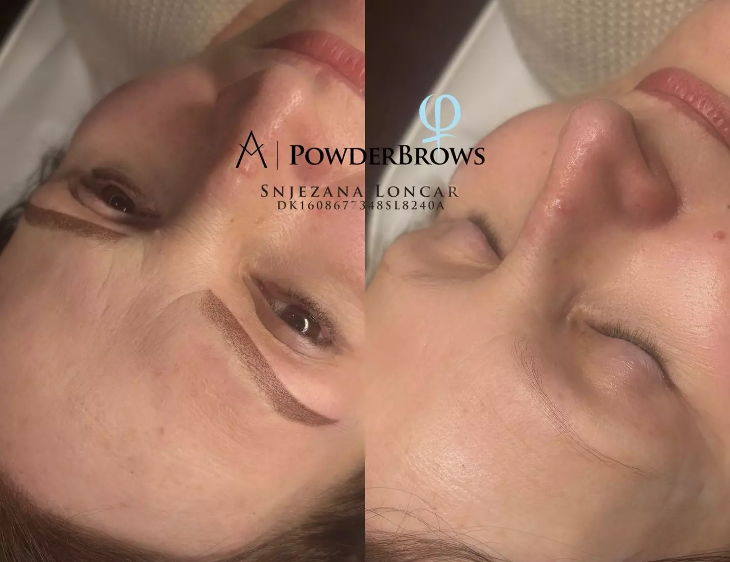 Epilacija Laserska epilacija Zadar, Hrvatska