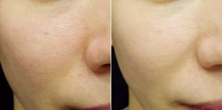 NekirurškiliftingimicroneedlingtretmanilicaitijelaZagrebačkažupanija2