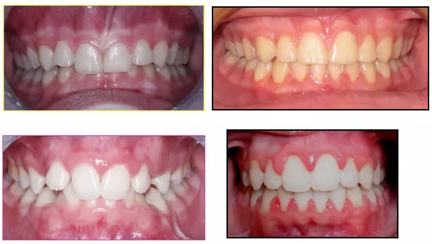 Povećanjezubnekostimatičnimstanicama,Rovinj6