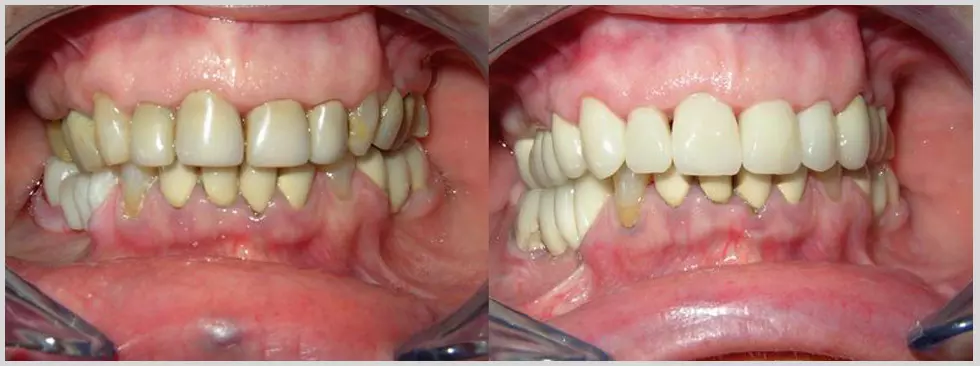 Najbolja fiksna i mobilna protetika estetska stomatologija u Velom Lošinju