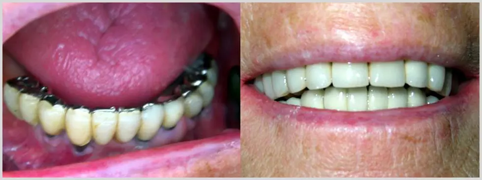 Profesionalno liječenje i pregledi zubi usluge endodoncije u Velom Lošinju