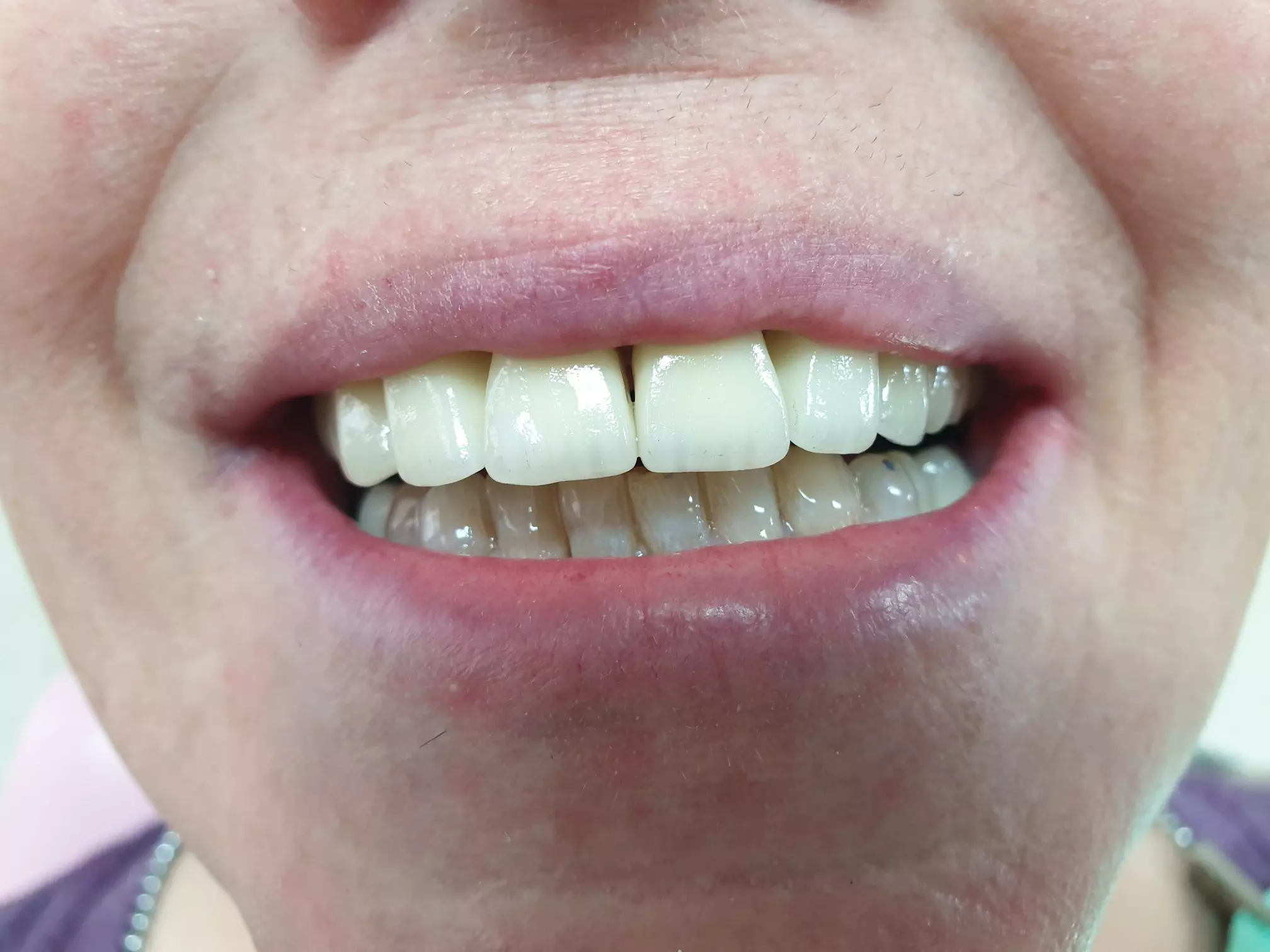 Izbjeljivanje zubi Split, RH