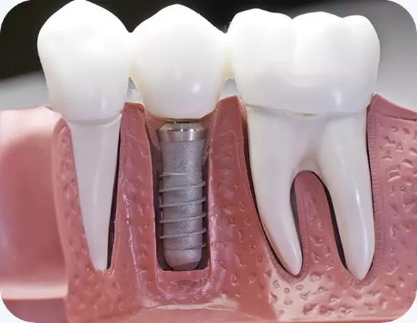 ZubniimplantatiRijeka2