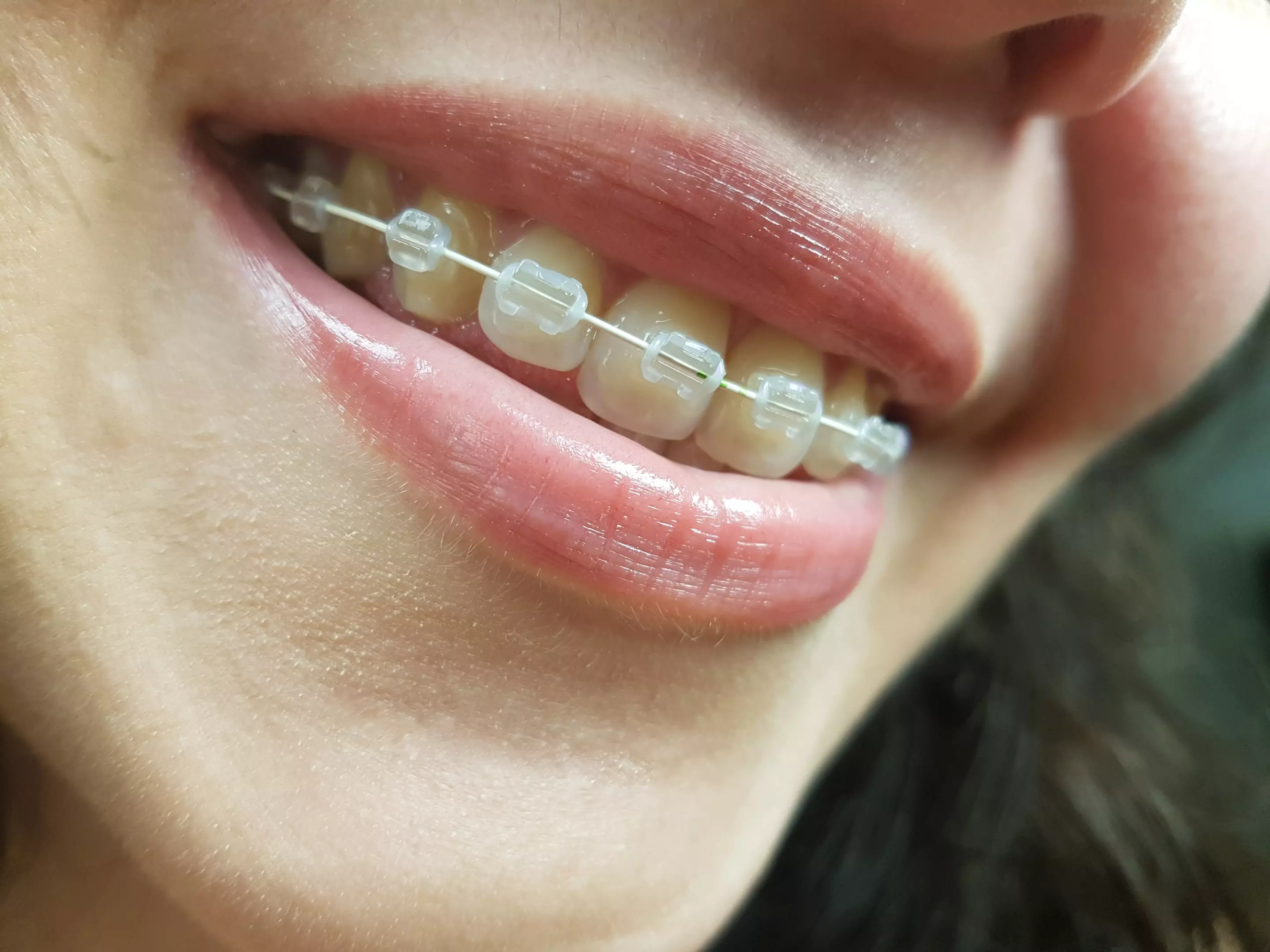 braces-brackets-close-up-2252154