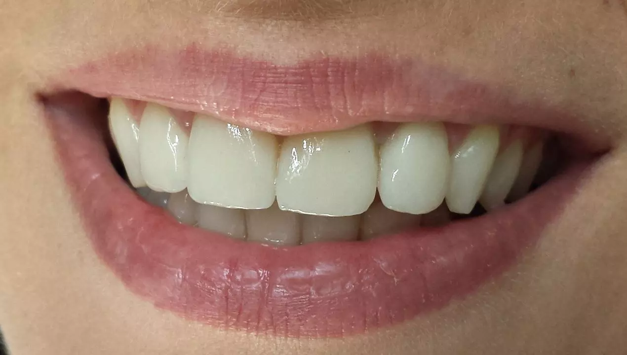 Estetske zubne krune, bezmetalne krunice, Zagreb